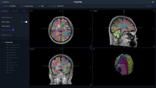 VUNO Med-DeepBrain analyzes brain MRI images based on deep learning, executes parcellation into more than 100 brain areas, and provides each area’s quantified degree of atrophy within one minute.