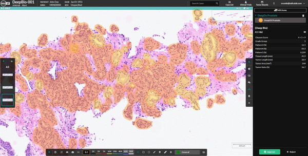 A screenshot of Deep Bio's prostate cancer diagnostic software, DeepDx Prostate, together with HALO AP's analysis platform is demonstrated in the image.
