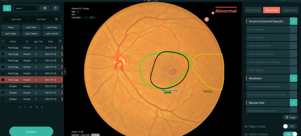 The figure shows a screenshot of VUNO Med-Fundus AI which can be used to aid diagnosis of retinal diseases.