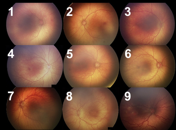 The image shows posterior poles classified from 1 to 9 stages according to the severity of retinopathy of prematurity (ROP) in prematurely born babies.
