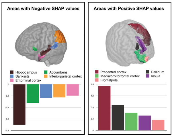 Left is the visualization of the top five brain regions representing feature impacts pushing the model's decision to AD, along with average feature impact. Right is the visualization of the top five brain regions representing feature impacts pushing the model's decision to healthy controls, along with moderate feature impact. (Credit: American Journal of Neuroradiology)