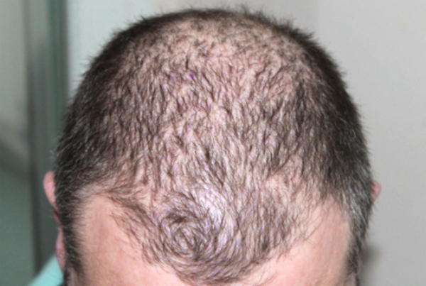 Inscobee said Thursday that it has acquired the U.S. patent for its bio-implant technology that promotes hair growth.