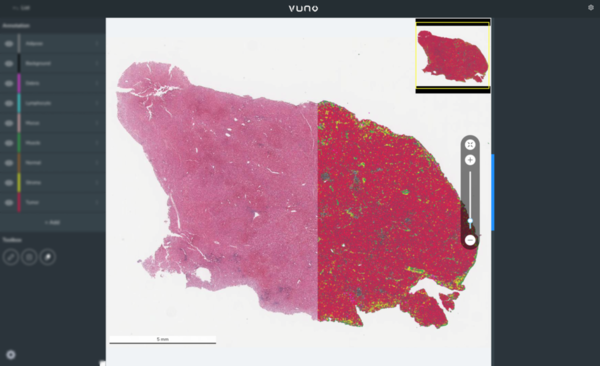 VUNO Med-PathLab quantifies pathology slides of liver cancer