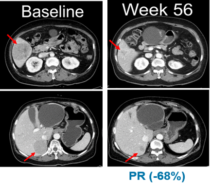Hanmi Pharmaceutical has released a computer tomography (CT) image of how belvarafenib induced 68 percent response at the 56th week of the study's baseline.