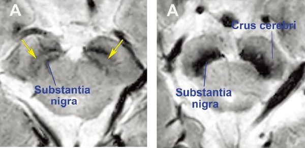 In the substantia nigra of a healthy person (left) and Parkinson’s patients, the black shadows show the loss of dopamine.