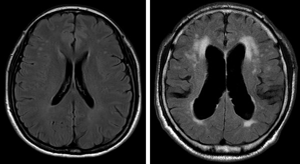 These are the MRI images of a healthy brain (left) and the brain of an NPH patient (right). The NPH patient’s brain shows an expanded cerebral ventricle due to accumulated cerebrospinal fluids.