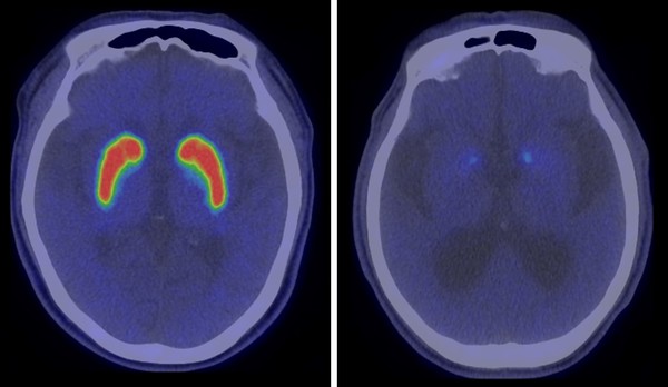 These are the PET scan comparison of a healthy brain (left) and the brain of a Parkinson’s patient (right). The brain of the Parkinson’s patient shows a weak response in the basal nuclear site.