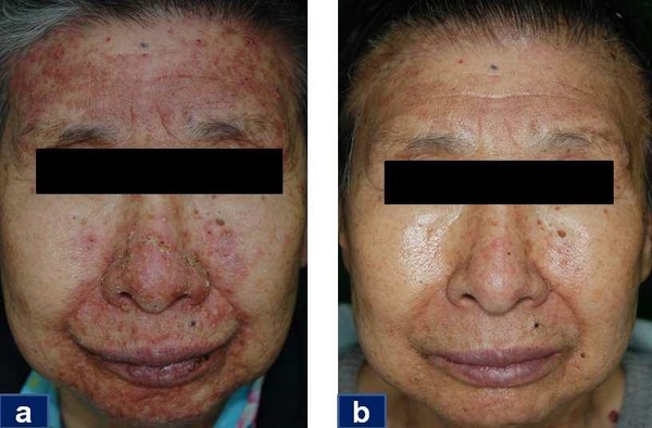 The left photo shows a face of a 74-year-old patient with non-small cell lung cancer who received erlotinib 150mg and experienced skin rash. The right photo shows improved skin legions four weeks after Easyef treatment.