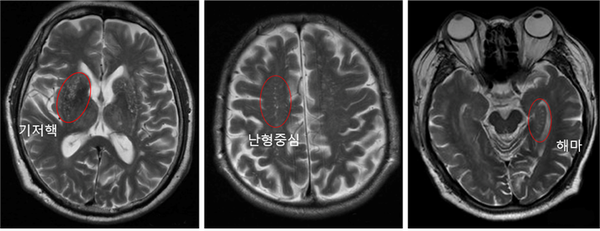 The brain MRI images of an Alzheimer’s patient with a severe degree of perivascular space dilation in the basal nucleus, ovoid center, and hippocampus areas (from left) (Source: Sanggye Paik Hospital)