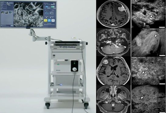 VPIX Medical's confocal microscope system, cCELL, (on the left) and MRI images of various brain tumors taken with cCELL are shown. (Credit: Korea University Anam Hospital)