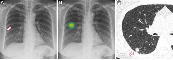 The pictures show a chest X-ray with a lung nodule detected by AI. The patient was diagnosed with lung cancer in an actual biopsy. (Credit: SNUH) 