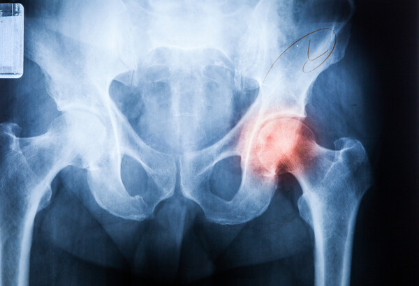 A research team at Seoul National University Bundang Hospital has proven the safety of fourth-generation ceramic facets used for artificial hip joint replacement surgery. (Credit: Getty Images)