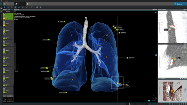 Coreline Soft also achieved pre-market approval from the Brazilian Health Regulatory Agency (ANVISA) for its AVIEW portfolio which comprises AVIEW LCS, AVIEW COPD, AVIEW CAC, AVIEW Modeler, and AVIEW RT ACS for diagnosing lung-based defects. (Credit: Coreline Soft)