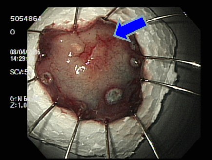 Stomach cancer removed by endoscopic resection (blue arrow). (Courtesy of Seoul St. Mary's Hospital)