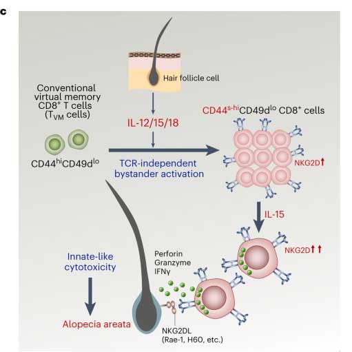 When virtual memory T-cells are activated by antigen-unspecific cytokine stimulation, they differentiate into new immune cells with high cytotoxicity, which release cytotoxic substances to destroy hair follicles and cause alopecia areata.