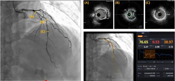 The diagram shows a representative case in which AI–based quantitative coronary angiography (AI-QCA) showed a good correlation with intravascular ultrasound (IVUS) observation. (Credit: SNUBH)