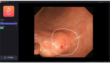 Waycen's gastric cancer image detection and diagnosis software, Waymed Endo ST CS