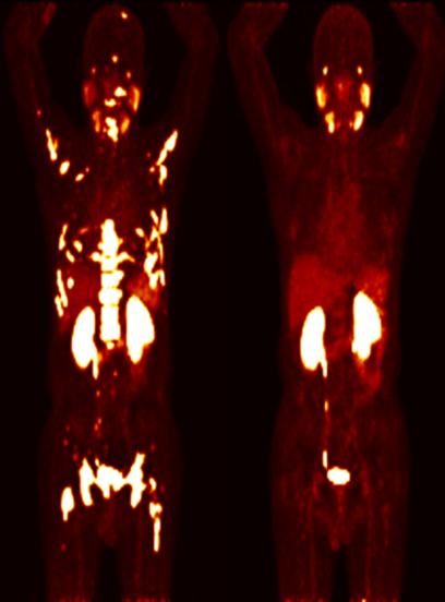 Comparison of before (PSA 823.8) and after (PSA:0.33) treatment with Lu-177-DGUL.  PSMA PET/CT images of a prostate cancer patient showed that the prostate cancer expressing PSMA protein was cured after treatment with Lu-177-DGUL, and the PSA level in the blood was restored to normal.
