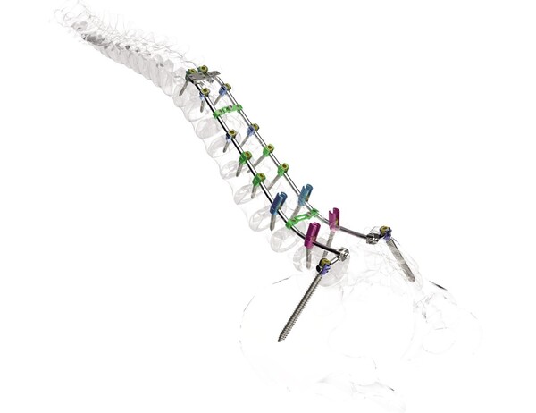 CG Bio said on Monday that the Advanced LumFix Spinal Fixation System (Advanced LumFix), an implant and surgical device for spinal correction, has received 510(k) clearance from the FDA.  (Credit: CG  Bio)