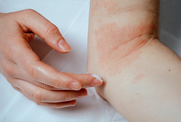 The number of people with atopic dermatitis has barely increased over the past five years, but its treatment cost has doubled. (Credit: Getty Images)