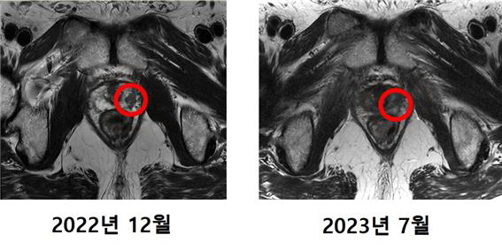 MRI scan of Choi. The previously detected cancerous tissue (left) is no longer visible post-treatment. (Credit: Severance Hospital)