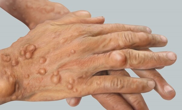 A patient with neurofibromatosis in the hands (Courtesy of Asan Medical Center)