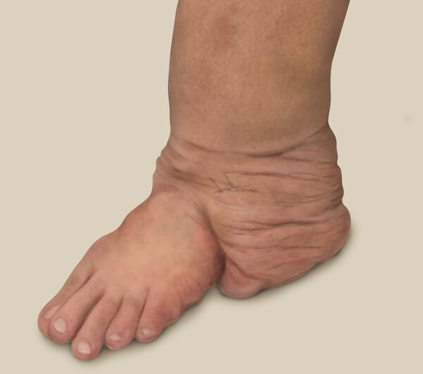 Neurofibromatosis on the feet and legs (Courtesy of Asan Medical Center)