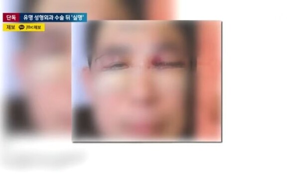 The picture shows the patient who received the under eye fat repositioning at a famous plastic surgery hospital in Sinsa-dong, southern Seoul. (screen captured from JTBC)