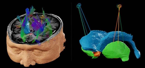 A schematic diagram of brain transplant surgery, in which both sides of the brain were equally implanted in the anterior, middle, and posterior parts of the putamen area of the brain which is involved in learning and motor control, including speech articulation and language functions. (Credit: Severance Hospital)