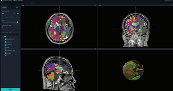 FDA granted 510k clearance to VUNO's AI-based brain imaging analysis medical device, VUNO Med-DeepBrain.