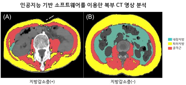 Abdominal CT images using AI-backed software. Left: adipopenia (+) Right: adipopenia (-) Courtesy of SNUH