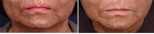 Before (left) and after treatment