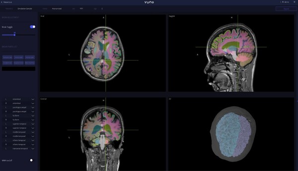 VUNO signed an MOU with Readycure to develop new dementia treatment medical devices. The picture shows a screen of VUNO Med-DeepBrain in operation. (Credit: VUNO)