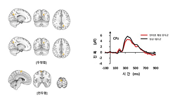 Functional MRI showed increased brain activity in the parietal and frontal regions of the brain in the online game addiction group compared to the control group. The amplitude of EEG signals in response to auditory stimuli was reduced in the online game addiction group (in red line) compared to the control group.