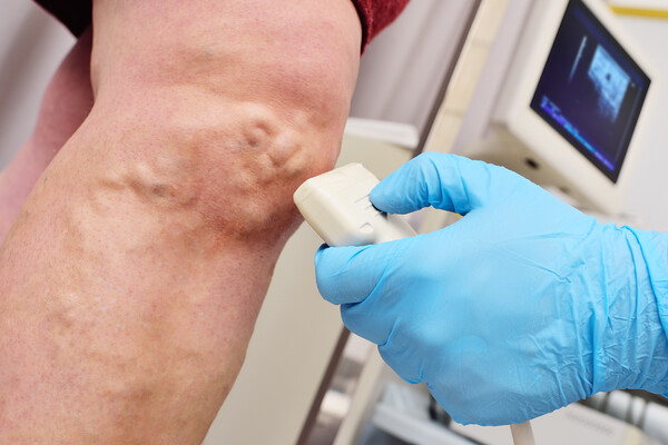 Surgery for varicose veins for cosmetic, not therapeutic purposes, will be covered by actual medical expense insurance. (Credit: Getty Images)