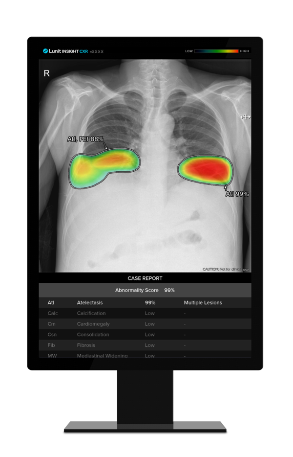 Lunit's INSIGHT CXR outperformed competitors in a study comparing seven products. (credit: Lunit)