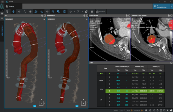 Coreline Soft’s AVIEW Aorta, a class 3 cardiovascular image detection and diagnostic auxiliary software