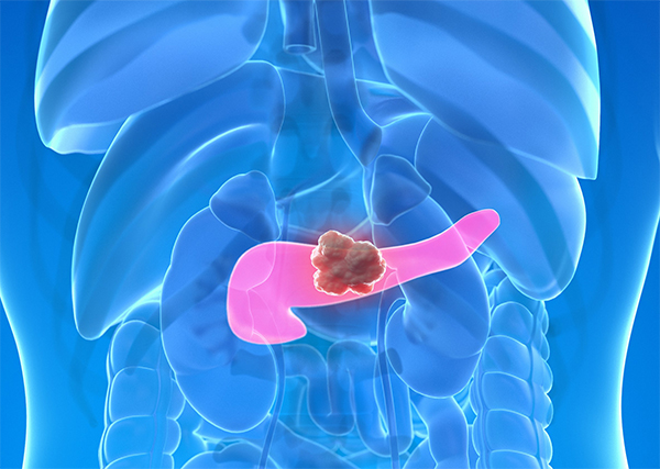 Pseudocysts, serous cysts, and mucinous cysts are watery sacs in the pancreas, and some of these cysts can develop into pancreatic cancer, called the serous cysts of the pancreas. (Credit: Getty Images)
