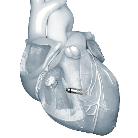 Micropace Pacemaker Medtronic brings new Micra pacemakers to Korea, but doctors say older ...