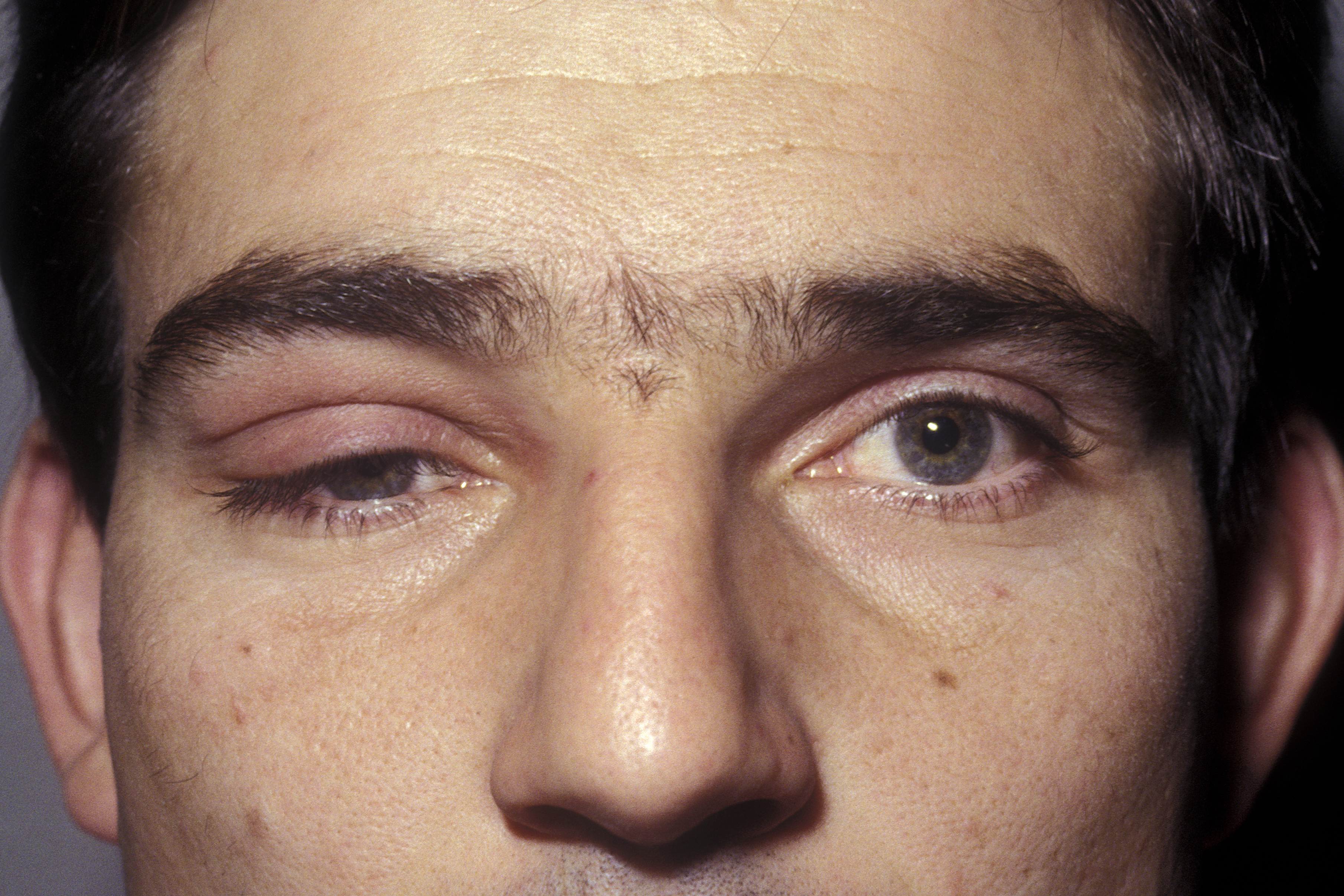 Persistent drooping eyelids may signal myasthenia gravis, specialist warns