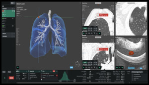 Coreline Soft joins AstraZeneca, Swiss KSA hospital in lung cancer AI study