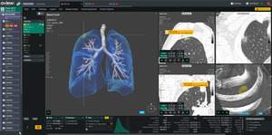 Coreline Soft supplies lung screening AI to Germany’s Charité hospital