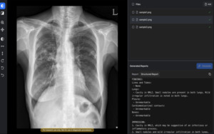 Korea clears first generative AI device that drafts chest X-ray reports